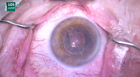 Chirurgia della cataratta con incisione da 2.2 mm con R-evolution – Dott. Pasquale Petrella