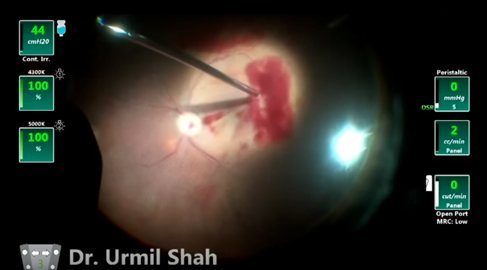 Vitrectomia 25G con R-evolution CR - Dott. Urmil Shah