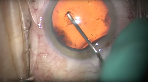 Chirurgia della Cataratta con R-Evolution - punta faco biconica 21G – Congresso AICCER 2015 - Dott. Sergio Manuel Solarino
